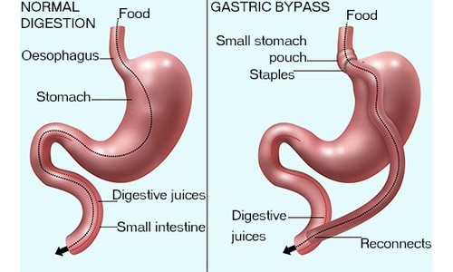 Weight Loss Surgery